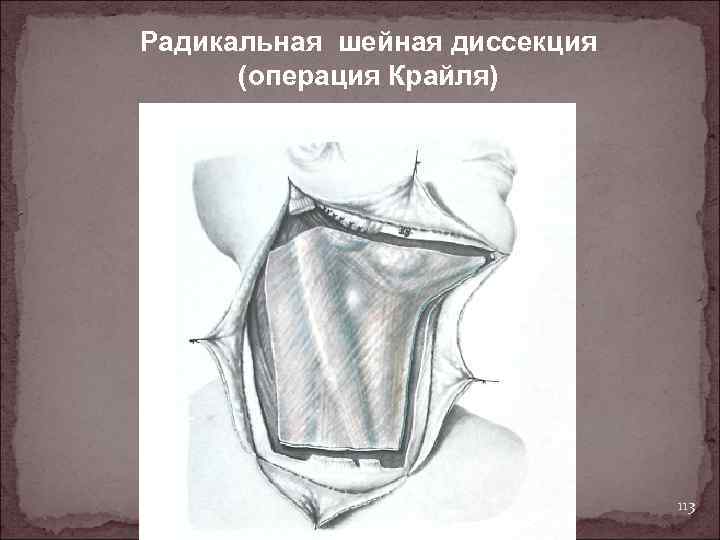 Радикальная шейная диссекция (операция Крайля) 113 