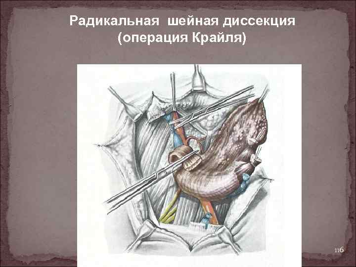 Радикальная шейная диссекция (операция Крайля) 116 