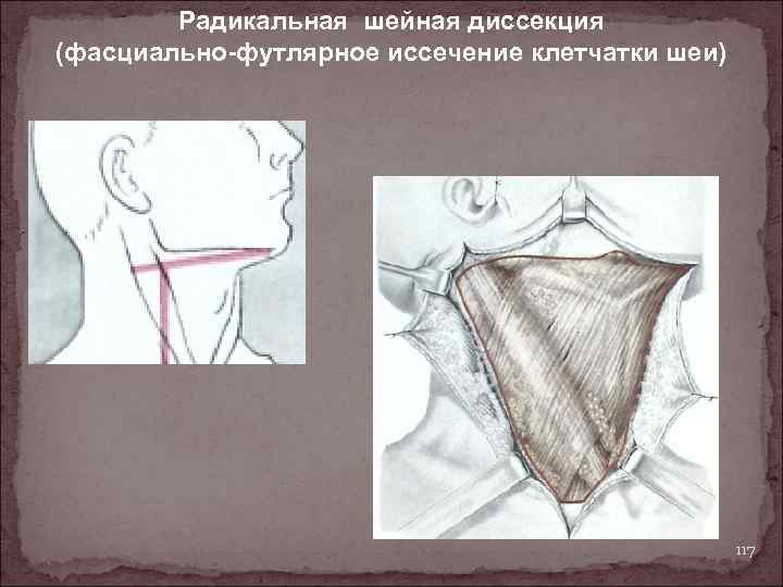 Радикальная шейная диссекция (фасциально-футлярное иссечение клетчатки шеи) 117 