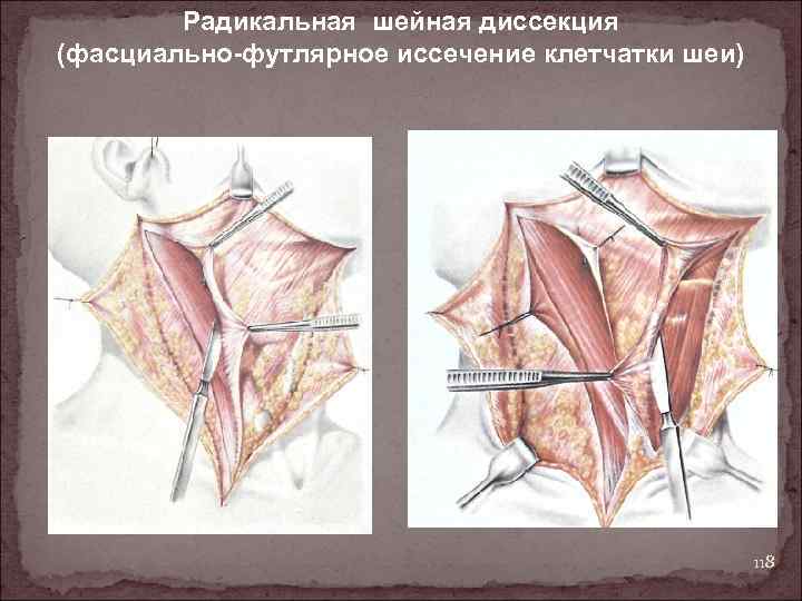 Радикальная шейная диссекция (фасциально-футлярное иссечение клетчатки шеи) 118 