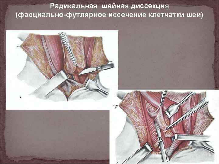 Радикальная шейная диссекция (фасциально-футлярное иссечение клетчатки шеи) 119 