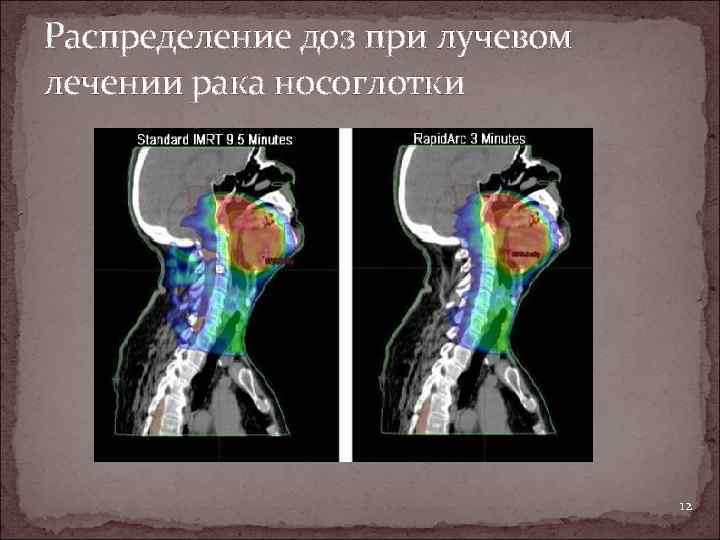 Распределение доз при лучевом лечении рака носоглотки 12 