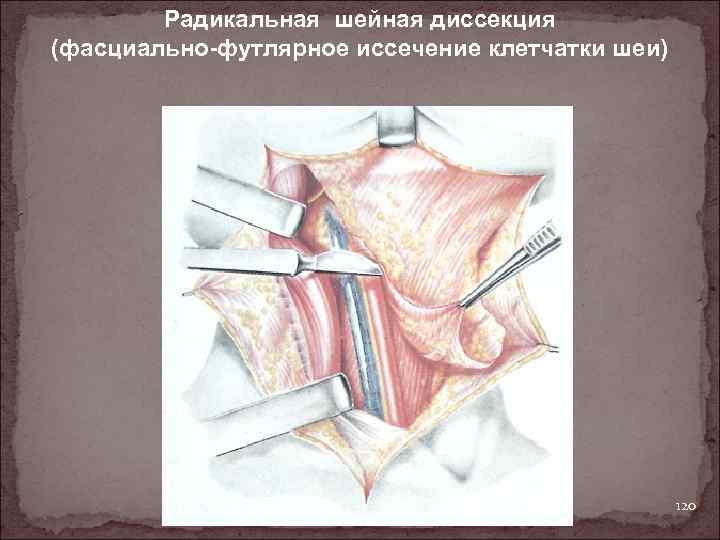 Радикальная шейная диссекция (фасциально-футлярное иссечение клетчатки шеи) 120 