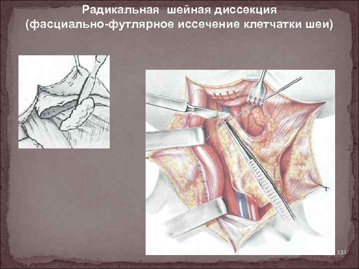 Радикальная шейная диссекция (фасциально-футлярное иссечение клетчатки шеи) 121 