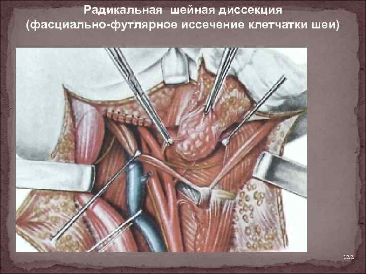 Радикальная шейная диссекция (фасциально-футлярное иссечение клетчатки шеи) 122 