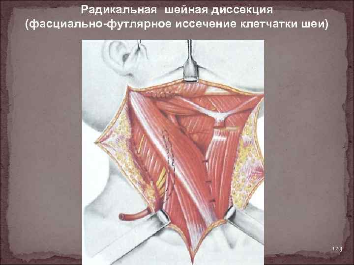 Радикальная шейная диссекция (фасциально-футлярное иссечение клетчатки шеи) 123 