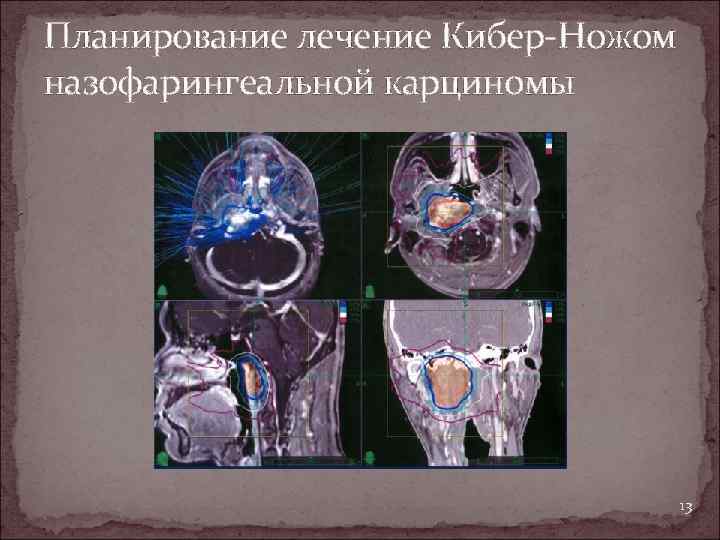 Планирование лечение Кибер-Ножом назофарингеальной карциномы 13 