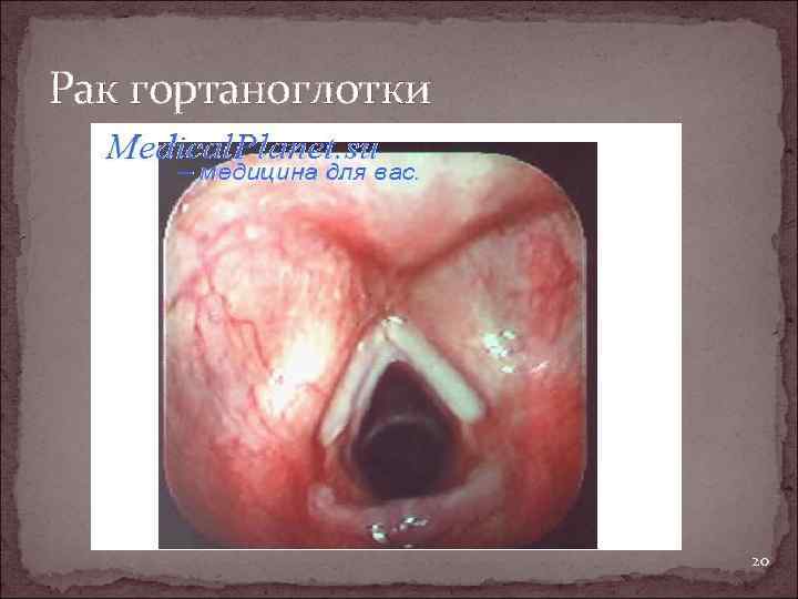 Рак гортаноглотки 20 