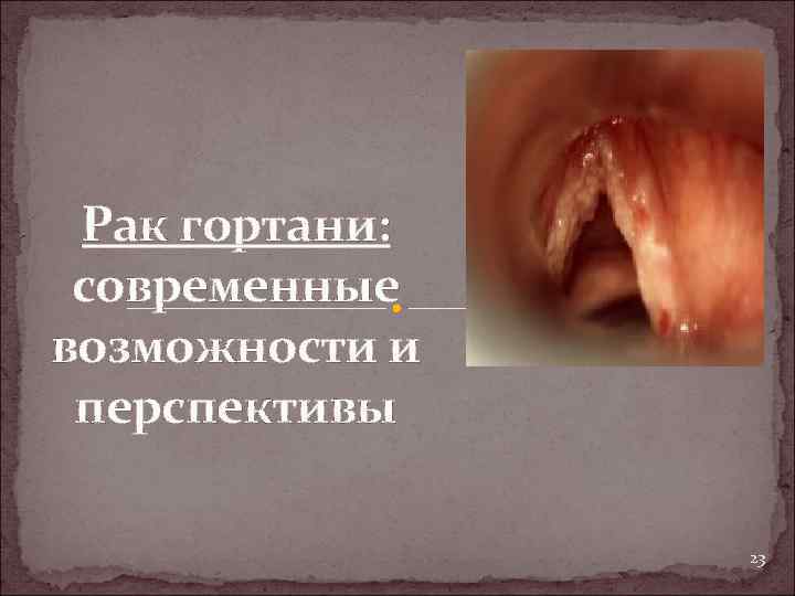 Рак гортани: современные возможности и перспективы 23 