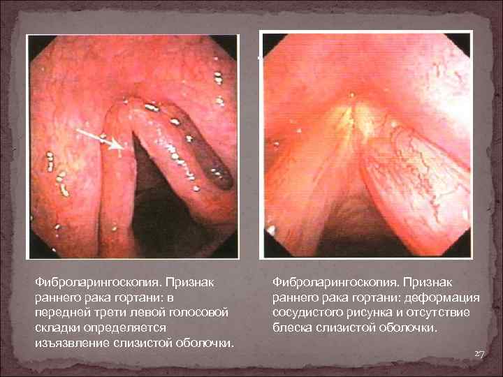 . Фиброларингоскопия. Признак раннего рака гортани: в передней трети левой голосовой складки определяется изъязвление