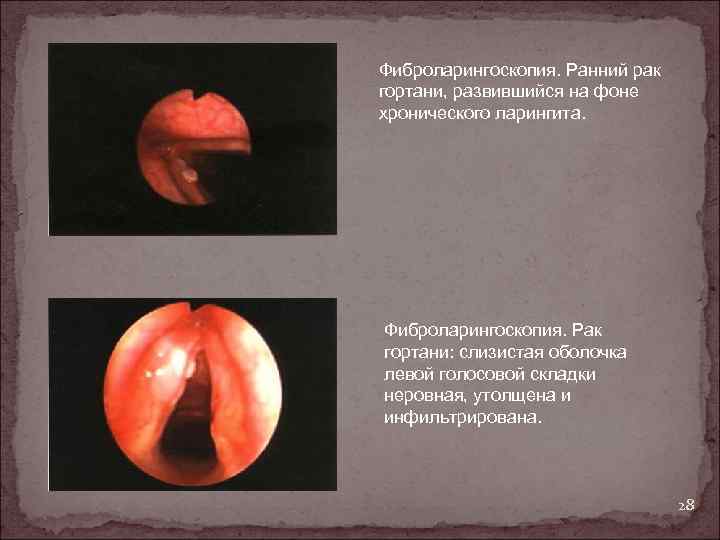 Фиброларингоскопия. Ранний рак гортани, развившийся на фоне хронического ларингита. Фиброларингоскопия. Рак гортани: слизистая оболочка
