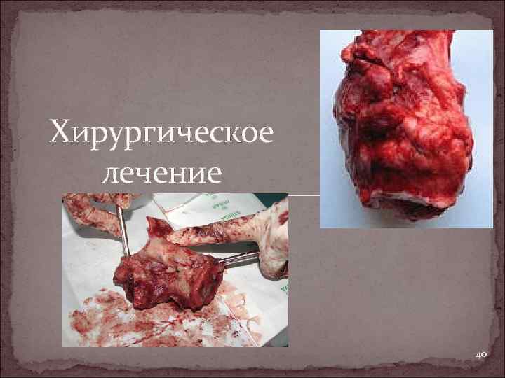 Хирургическое лечение 40 