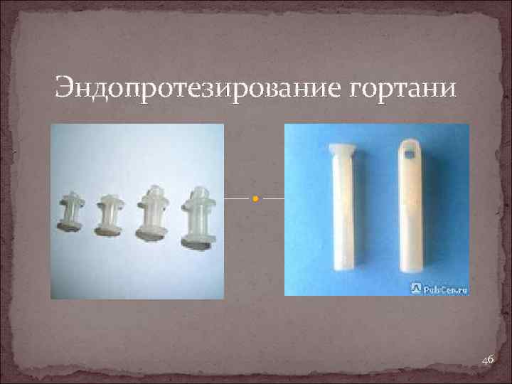 Эндопротезирование гортани 46 