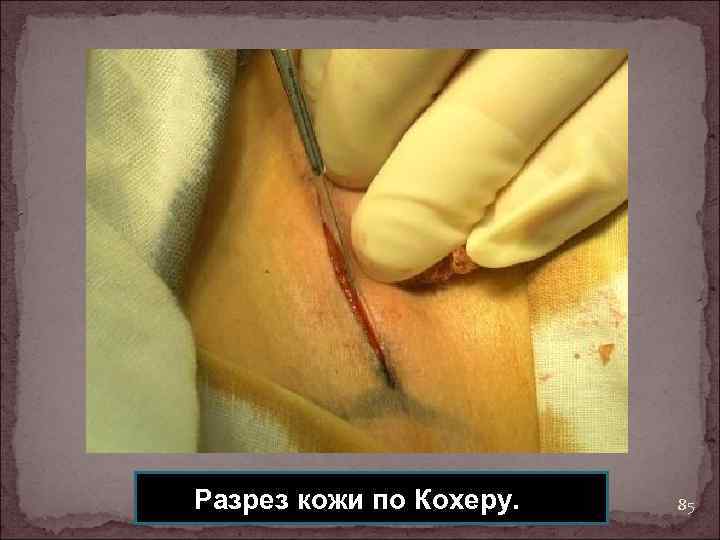 Разрез кожи по Кохеру. 85 