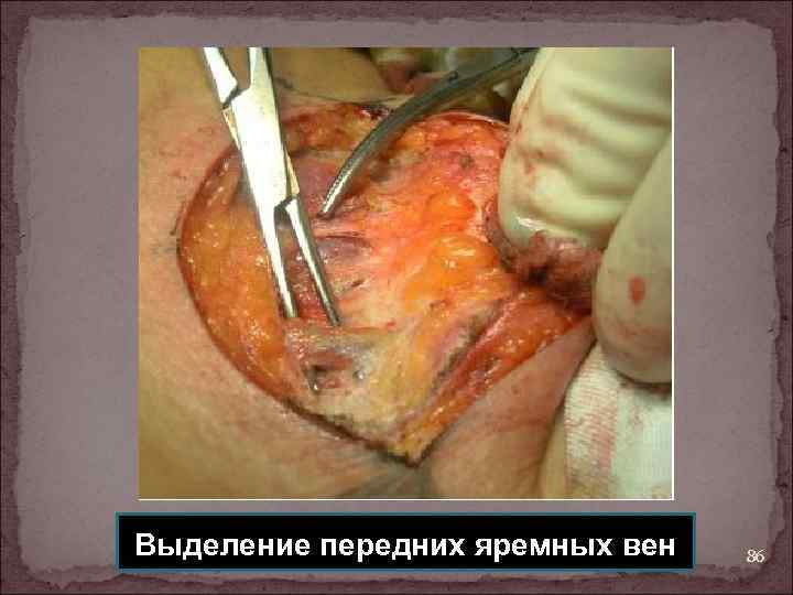 Выделение передних яремных вен 86 