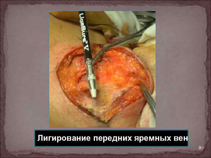 Лигирование передних яремных вен 87 