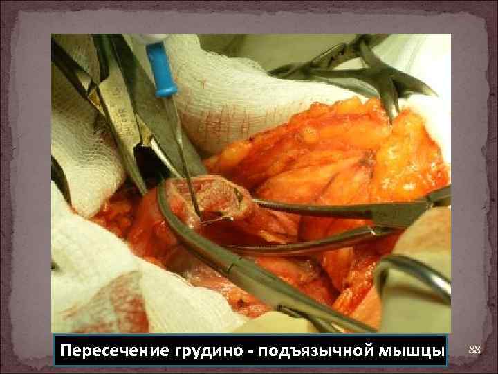 Пересечение грудино - подъязычной мышцы 88 
