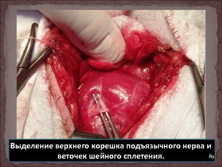 Выделение верхнего корешка подъязычного нерва и 89 веточек шейного сплетения. 