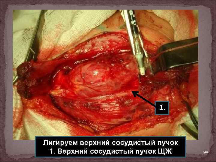 1. Лигируем верхний сосудистый пучок 1. Верхний сосудистый пучок ЩЖ 90 