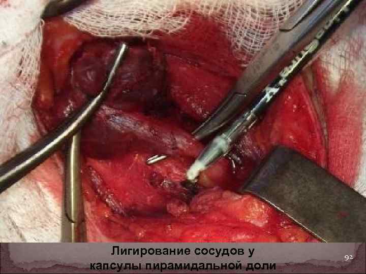 Лигирование сосудов у капсулы пирамидальной доли 92 