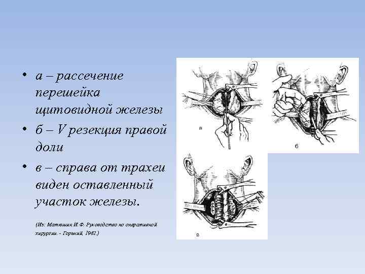  • а – рассечение перешейка щитовидной железы • б – V резекция правой