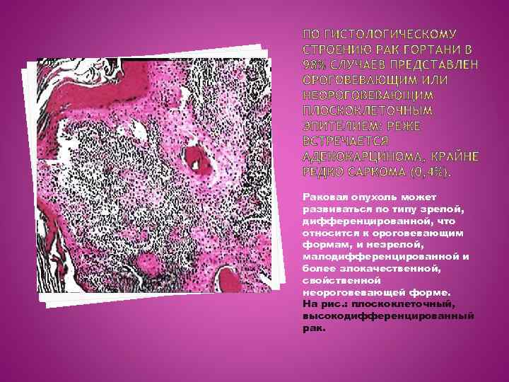 Раковая опухоль может развиваться по типу зрелой, дифференцированной, что относится к ороговевающим формам, и