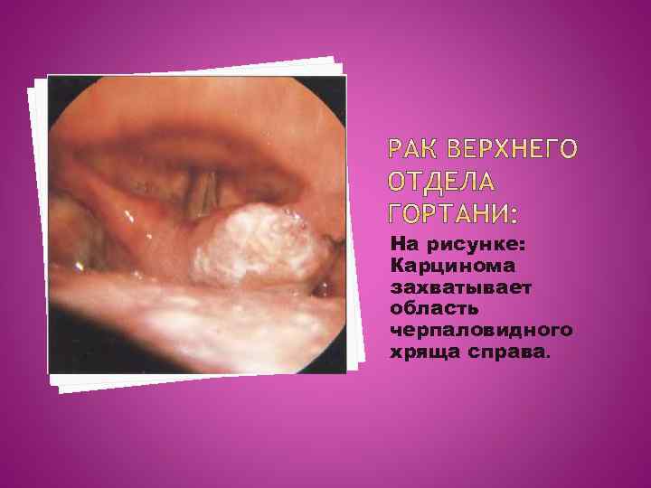 На рисунке: Карцинома захватывает область черпаловидного хряща справа. 