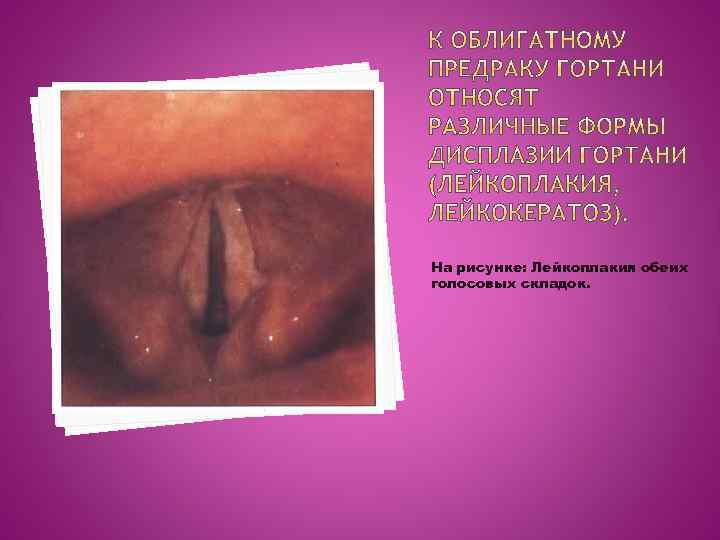 На рисунке: Лейкоплакия обеих голосовых складок. 