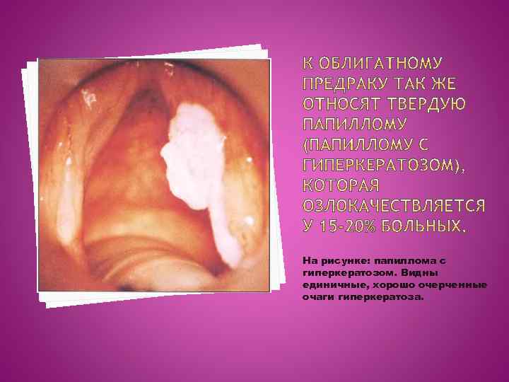 На рисунке: папиллома с гиперкератозом. Видны единичные, хорошо очерченные очаги гиперкератоза. 