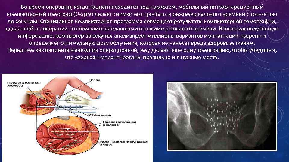 Во время операции, когда пациент находится под наркозом, мобильный интраоперационный компьютерный томограф (O-арм) делает