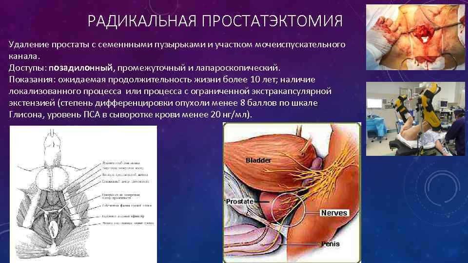 РАДИКАЛЬНАЯ ПРОСТАТЭКТОМИЯ Удаление простаты с семеннными пузырьками и участком мочеиспускательного канала. Доступы: позадилонный, промежуточный