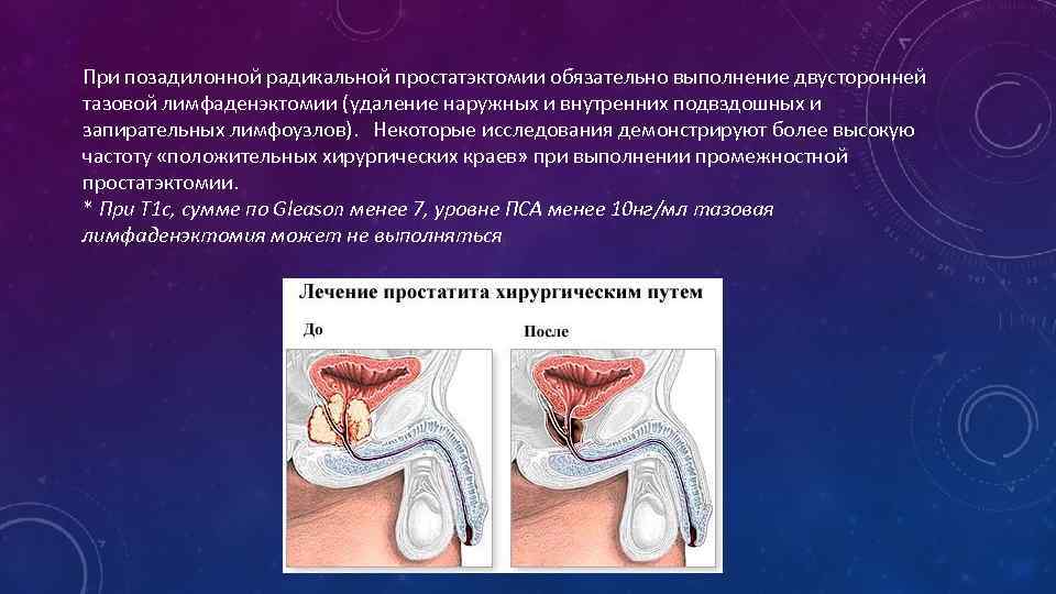 При позадилонной радикальной простатэктомии обязательно выполнение двусторонней тазовой лимфаденэктомии (удаление наружных и внутренних подвздошных