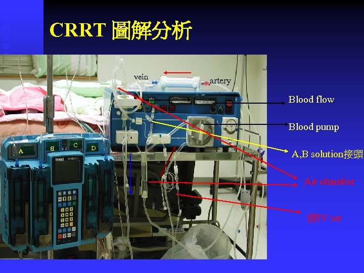 CRRT 圖解分析 vein artery Blood flow Blood pump A B C D A, B
