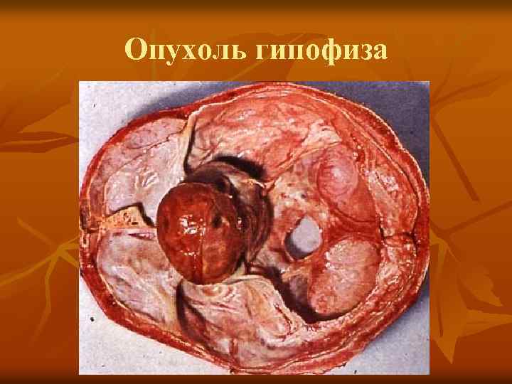 Опухоль гипофиза 