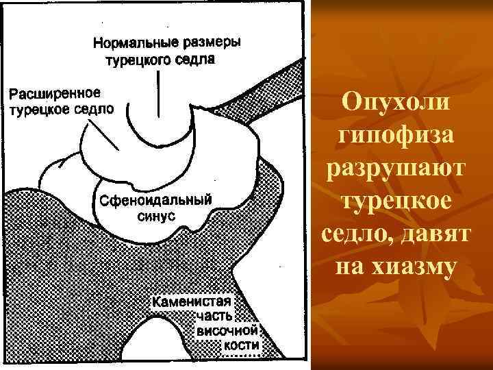 Опухоли гипофиза разрушают турецкое седло, давят на хиазму 