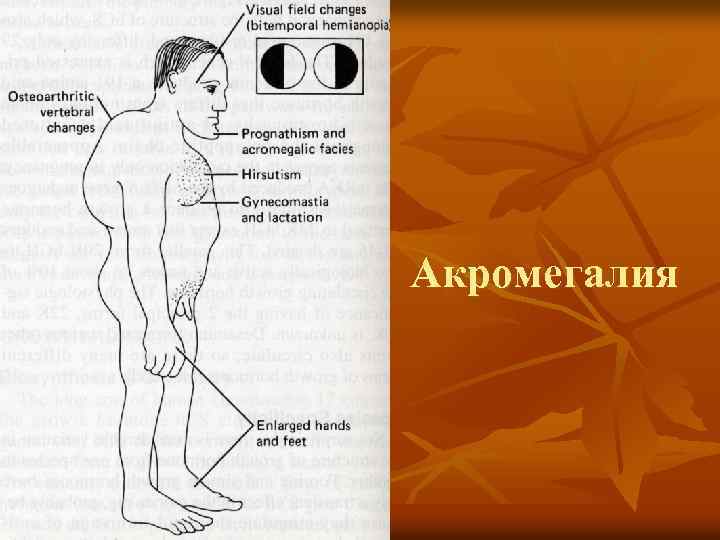 Акромегалия 