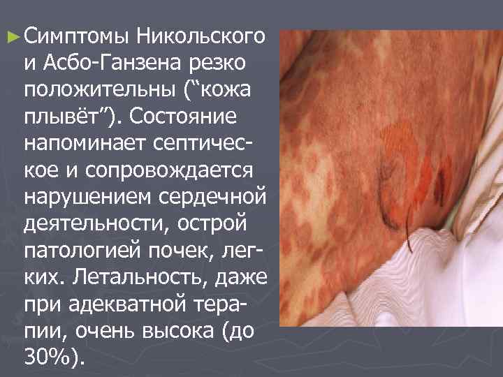 ► Симптомы Никольского и Асбо-Ганзена резко положительны (“кожа плывёт”). Состояние напоминает септическое и сопровождается