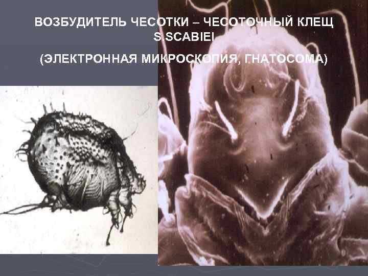 ВОЗБУДИТЕЛЬ ЧЕСОТКИ – ЧЕСОТОЧНЫЙ КЛЕЩ S. SCABIEI (ЭЛЕКТРОННАЯ МИКРОСКОПИЯ, ГНАТОСОМА) 