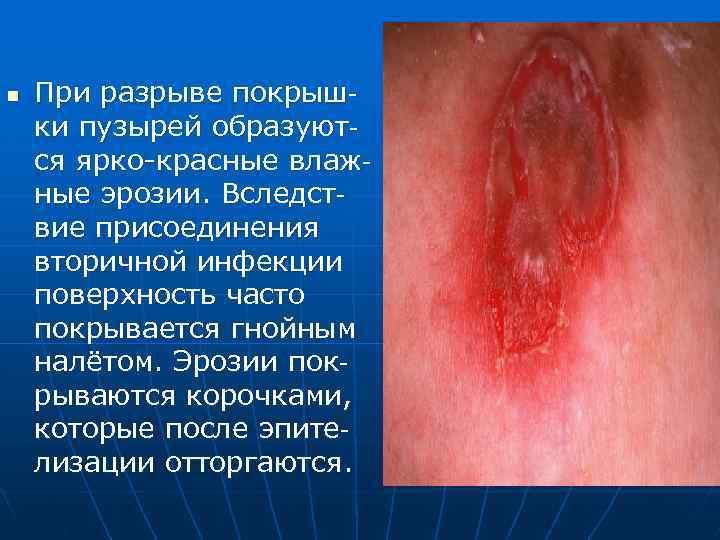 n При разрыве покрышки пузырей образуются ярко-красные влажные эрозии. Вследствие присоединения вторичной инфекции поверхность
