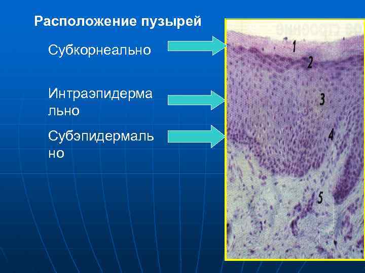 Расположение пузырей Субкорнеально Интраэпидерма льно Субэпидермаль но 