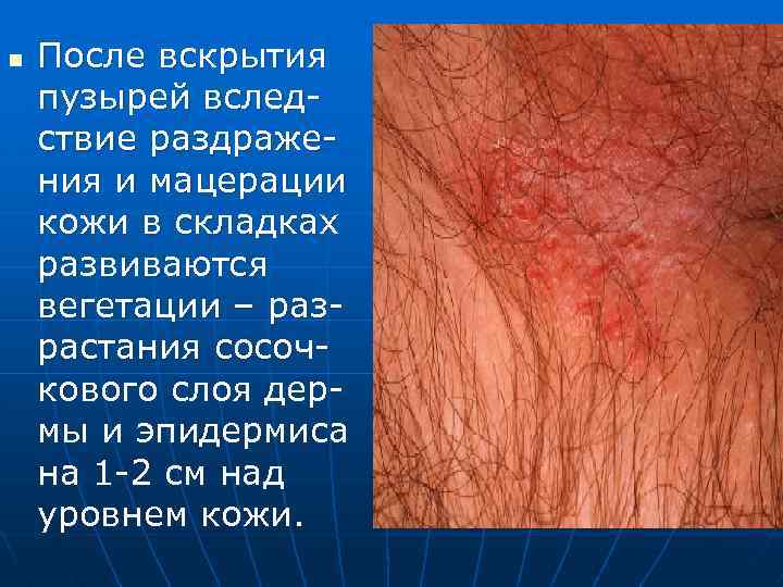 n После вскрытия пузырей вследствие раздражения и мацерации кожи в складках развиваются вегетации –