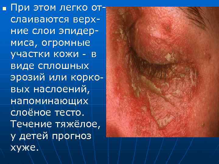 n При этом легко отслаиваются верхние слои эпидермиса, огромные участки кожи - в виде
