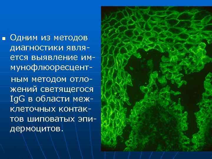 n Одним из методов диагностики является выявление иммунофлюоресцентным методом отложений светящегося Ig. G в