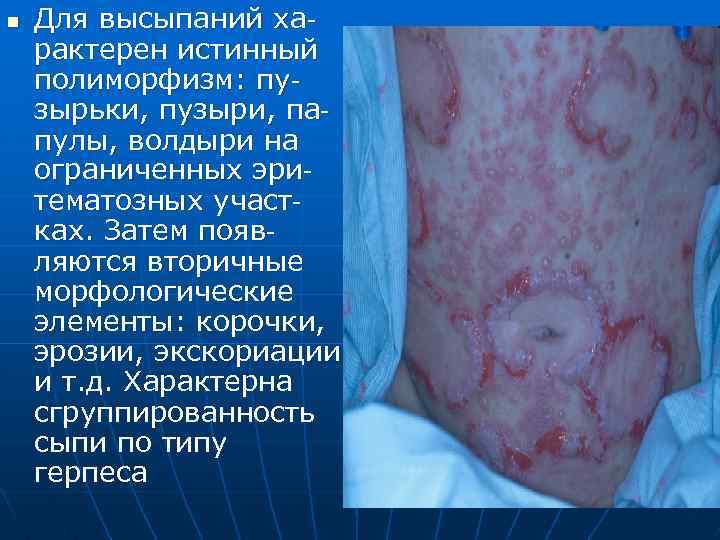 n Для высыпаний характерен истинный полиморфизм: пузырьки, пузыри, папулы, волдыри на ограниченных эритематозных участках.