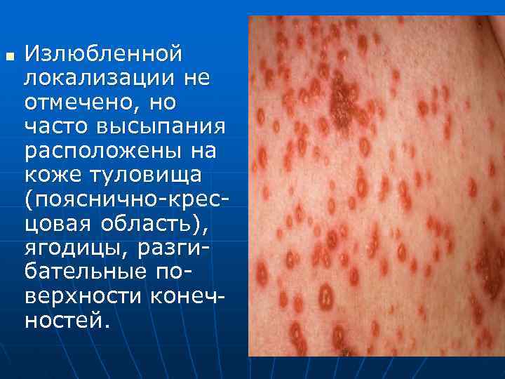 n Излюбленной локализации не отмечено, но часто высыпания расположены на коже туловища (пояснично-кресцовая область),