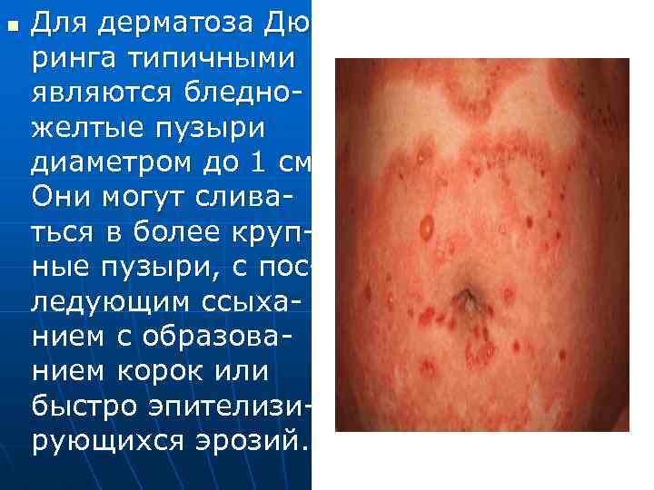 n Для дерматоза Дюринга типичными являются бледножелтые пузыри диаметром до 1 см. Они могут