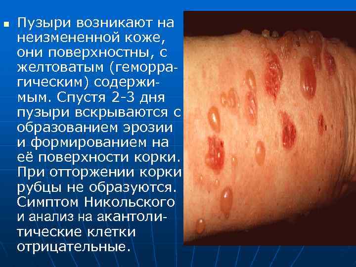n Пузыри возникают на неизмененной коже, они поверхностны, с желтоватым (геморрагическим) содержимым. Спустя 2