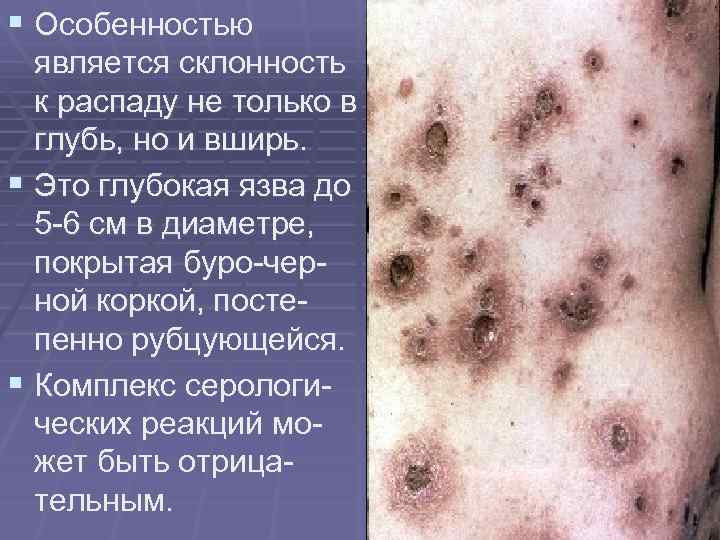 § Особенностью является склонность к распаду не только в глубь, но и вширь. §