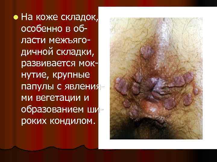 l На коже складок, особенно в области межъягодичной складки, развивается мокнутие, крупные папулы с