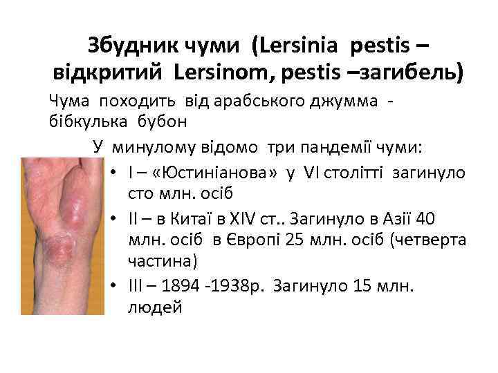 Збудник чуми (Lersinia pestis – відкритий Lersinom, pestis –загибель) Чума походить від арабського джумма